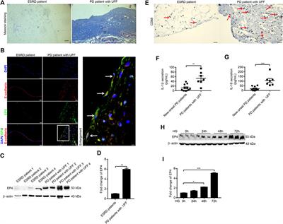 Blockade of prostaglandin E2 receptor 4 ameliorates peritoneal dialysis-associated peritoneal fibrosis